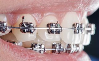 Tratamente ortodontice
