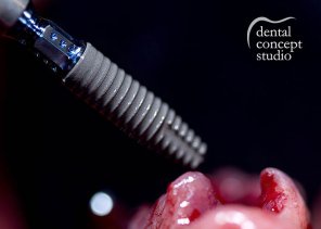 formare in implantologie bucharest Dental Concept Studio